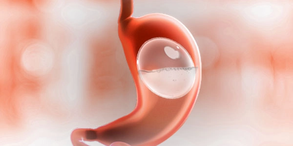 Intragastric Balloon